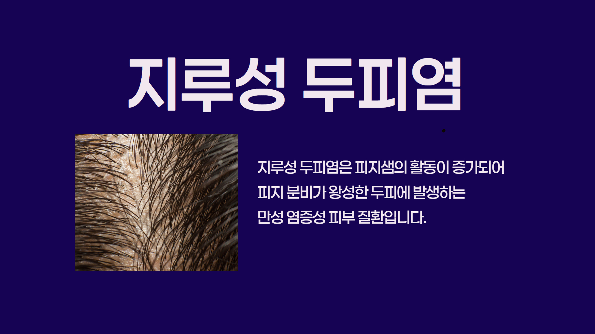 지루성 두피염 안내